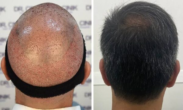 Hair Transplants for Those with Previous Transplant Failures: Is It Still Possible?